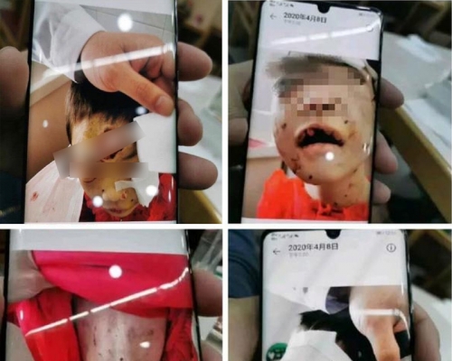 4歲女童疑遭繼母長期虐待,更被剪掉嘴唇。(網圖)