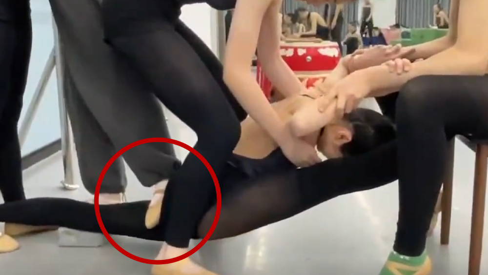 17歲舞蹈生拉筋被老師踩斷腳，終身無法再跳。