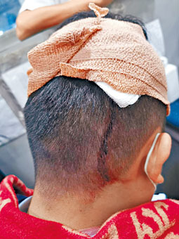 抄牌警员头部被石掟中受伤送院治理。