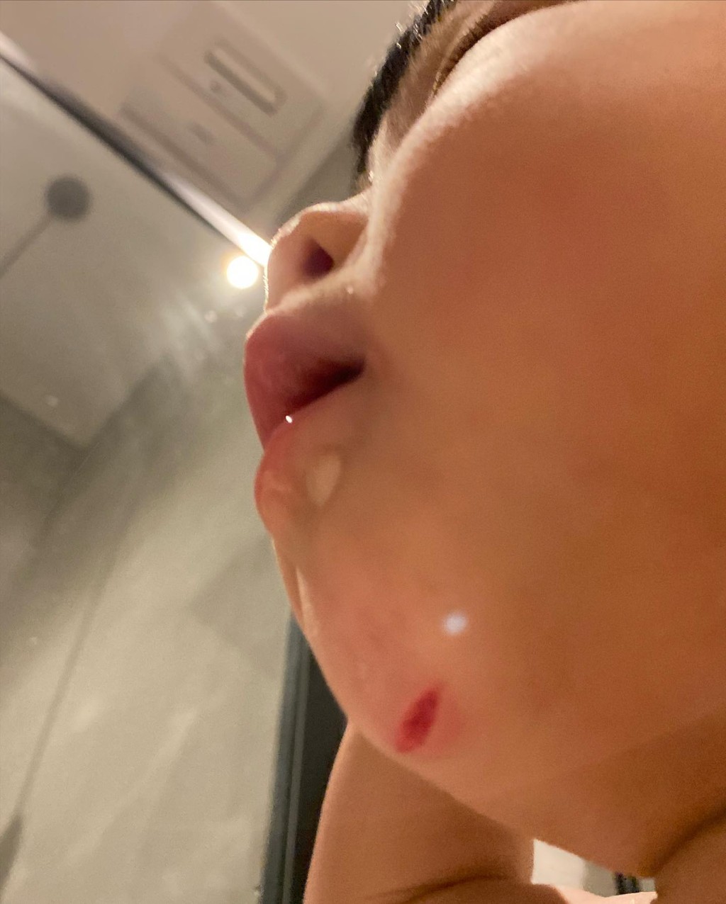 下巴最終要縫6針。