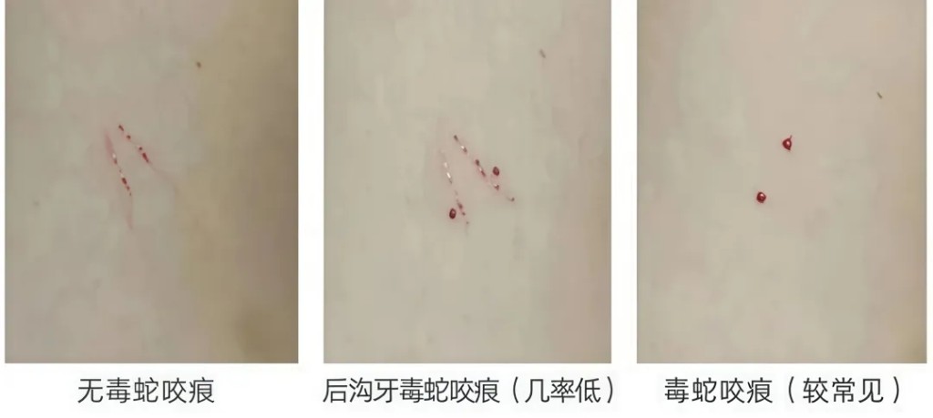 蛇类咬伤伤口对比图。 深圳市急救中心