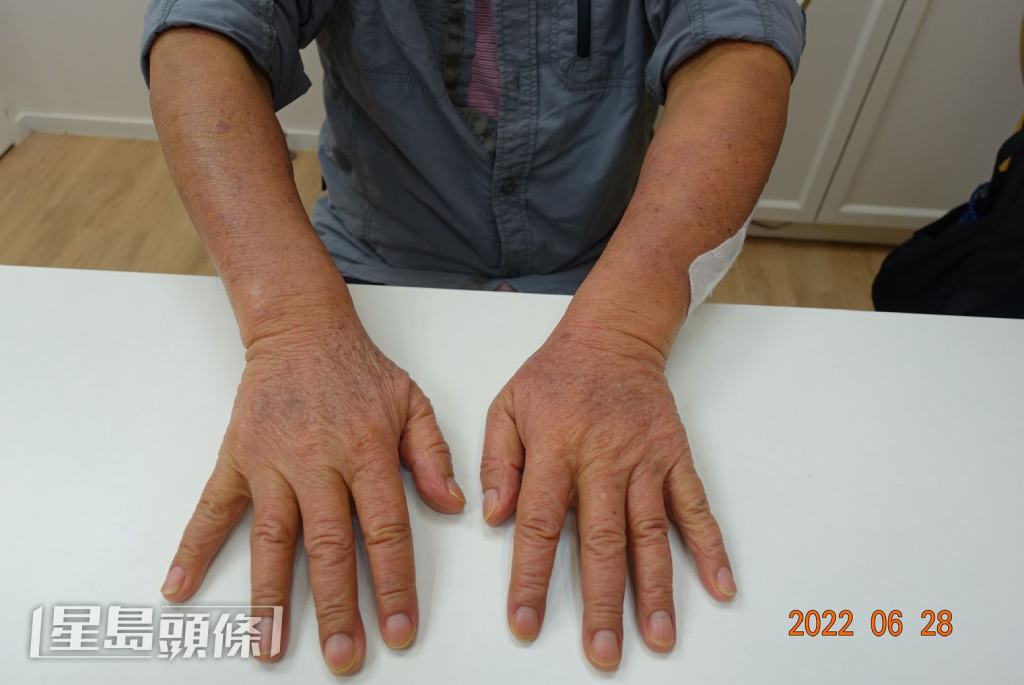 接受中醫治療後，伯伯雙手濕疹問題明顯改善。（相片由註冊中醫師李廣冀提供）