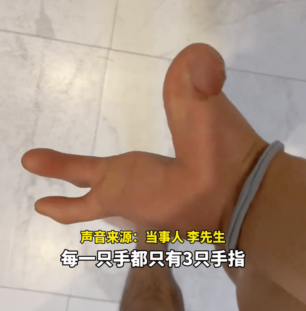 李先生每隻手只有三根手指。