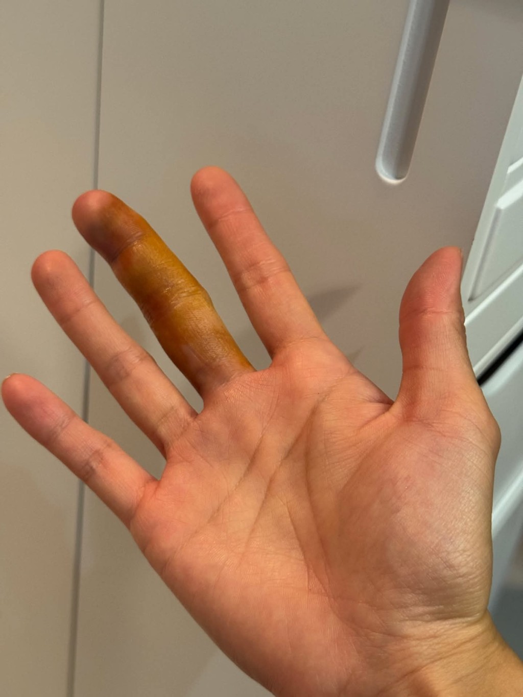 其中一名女受害人在社交平台表示,與疑犯拉扯期間,手指嚴重受傷。Threads截圖 其中一名女受害人在社交平台表示,與疑犯拉扯期間,手指嚴重受傷。Threads截圖