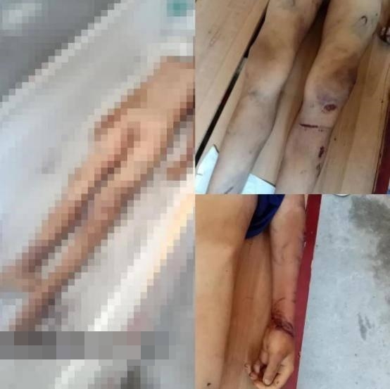 男童手腕上有被吊起來後留下的勒痕。 網圖