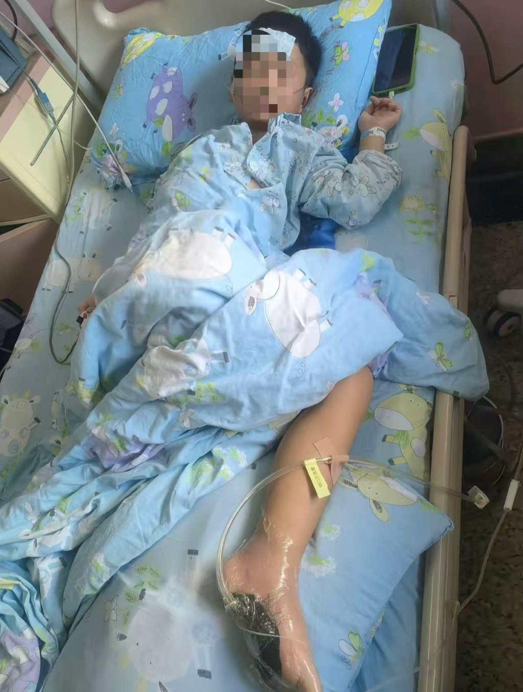6歲男童沙灘赤腳踩到死魚被扎傷,高燒昏迷險截肢。抖音@路過的風景 6歲男童沙灘赤腳踩到死魚被扎傷,高燒昏迷險截肢。抖音@路過的風景