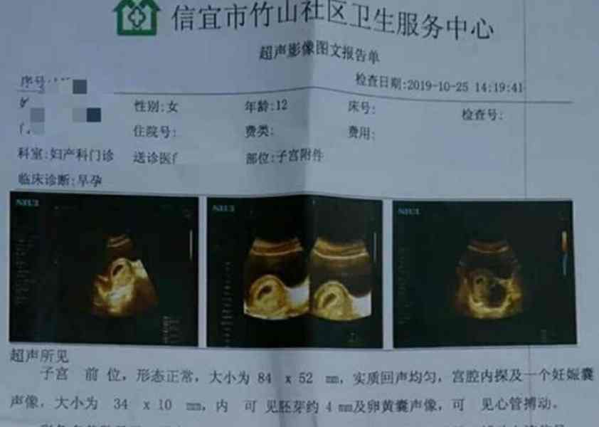 受害人12岁女孩小文1年内两度因奸成孕。网图