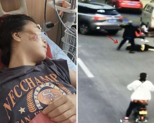 33歲的阿惠遭前男友駕車輾壓,導致全身多處受傷,身上縫合了30多針。(網圖)