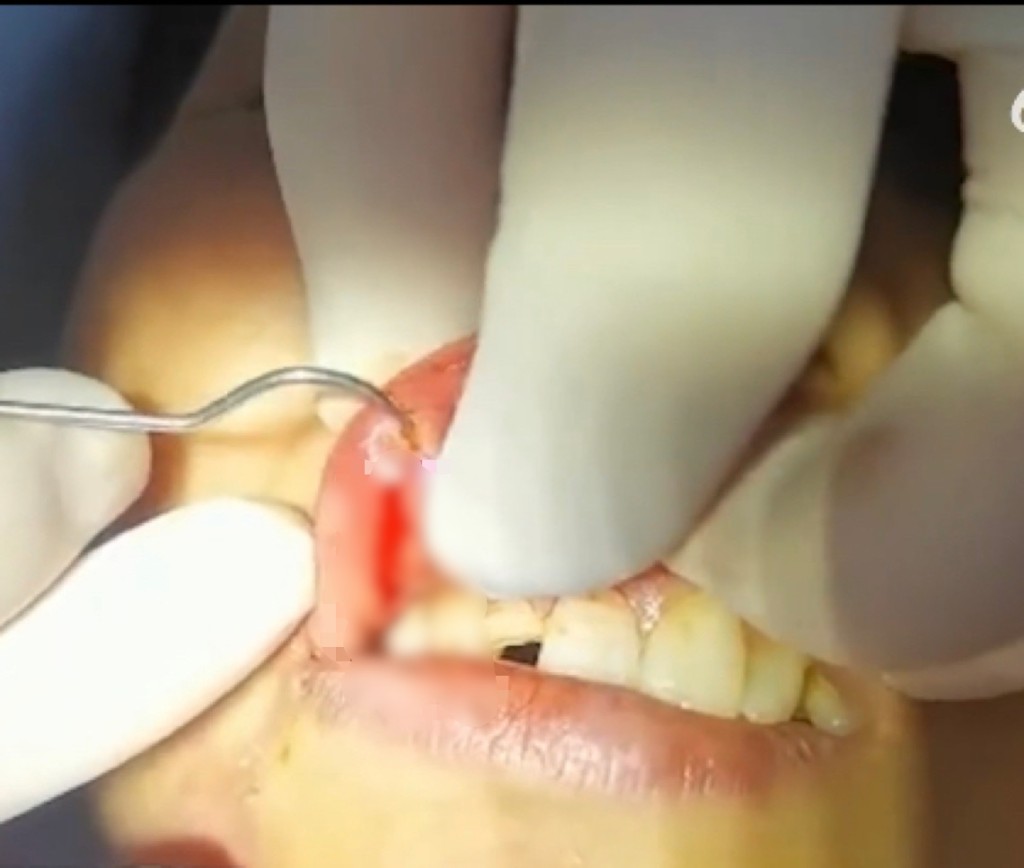 医护人员割开伤口取出断牙。  微博视频截图