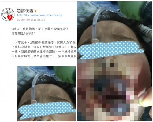 女童整個口腔遭各級燙傷。急診夜鷹微博圖片