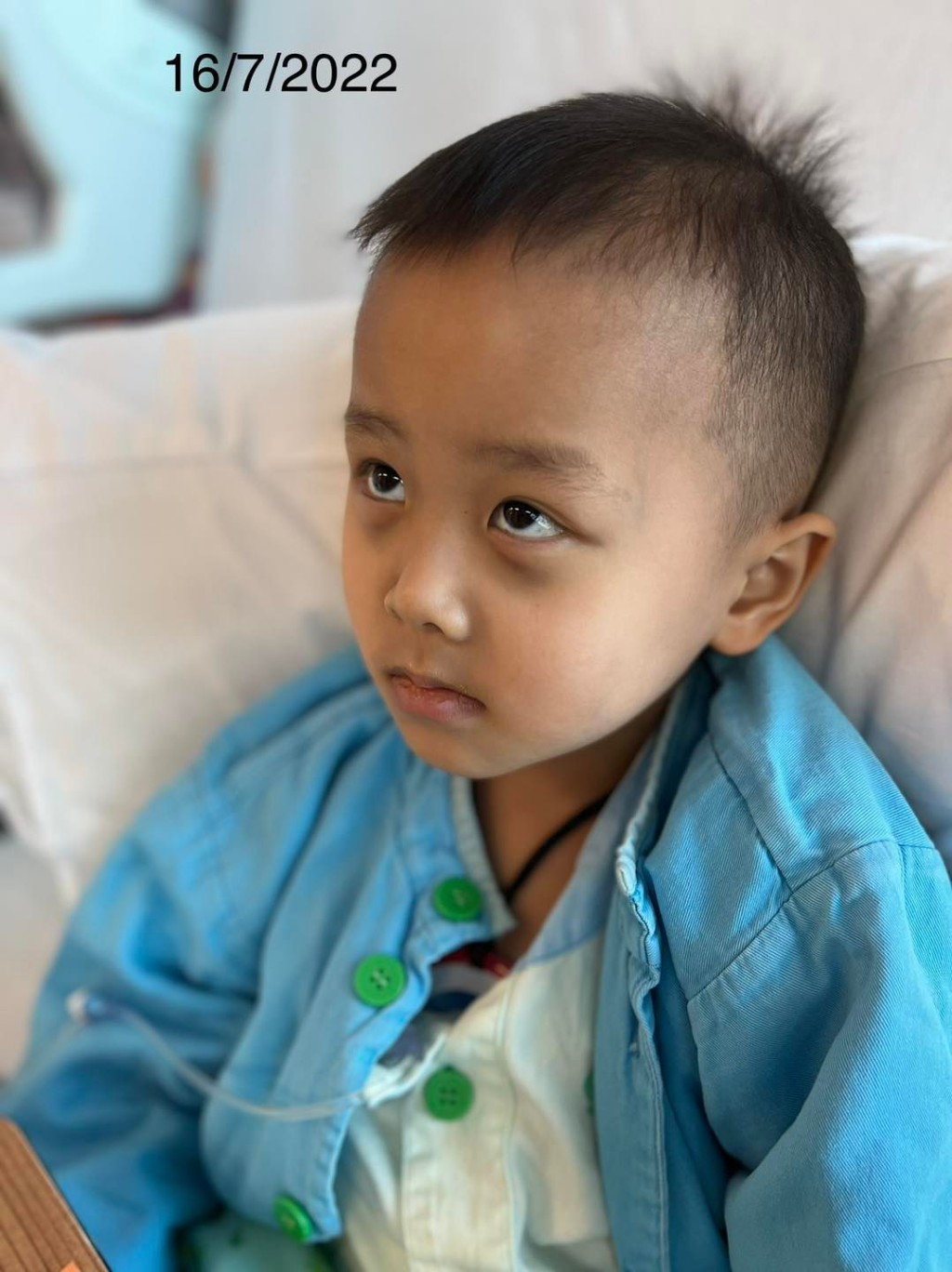 患神經母細胞瘤5歲童Sheldon上星期出現浣熊眼。（FB@神母小戰士Sheldon) 