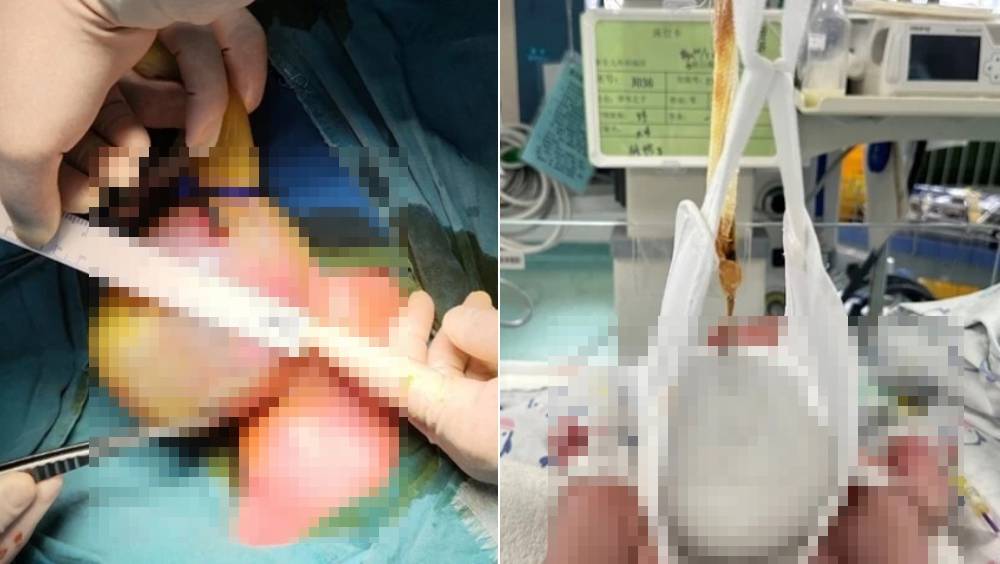 男嬰出世驚見「內臟外掛」如拳頭，武漢醫生創「懸吊法」花兩年令器官歸位。