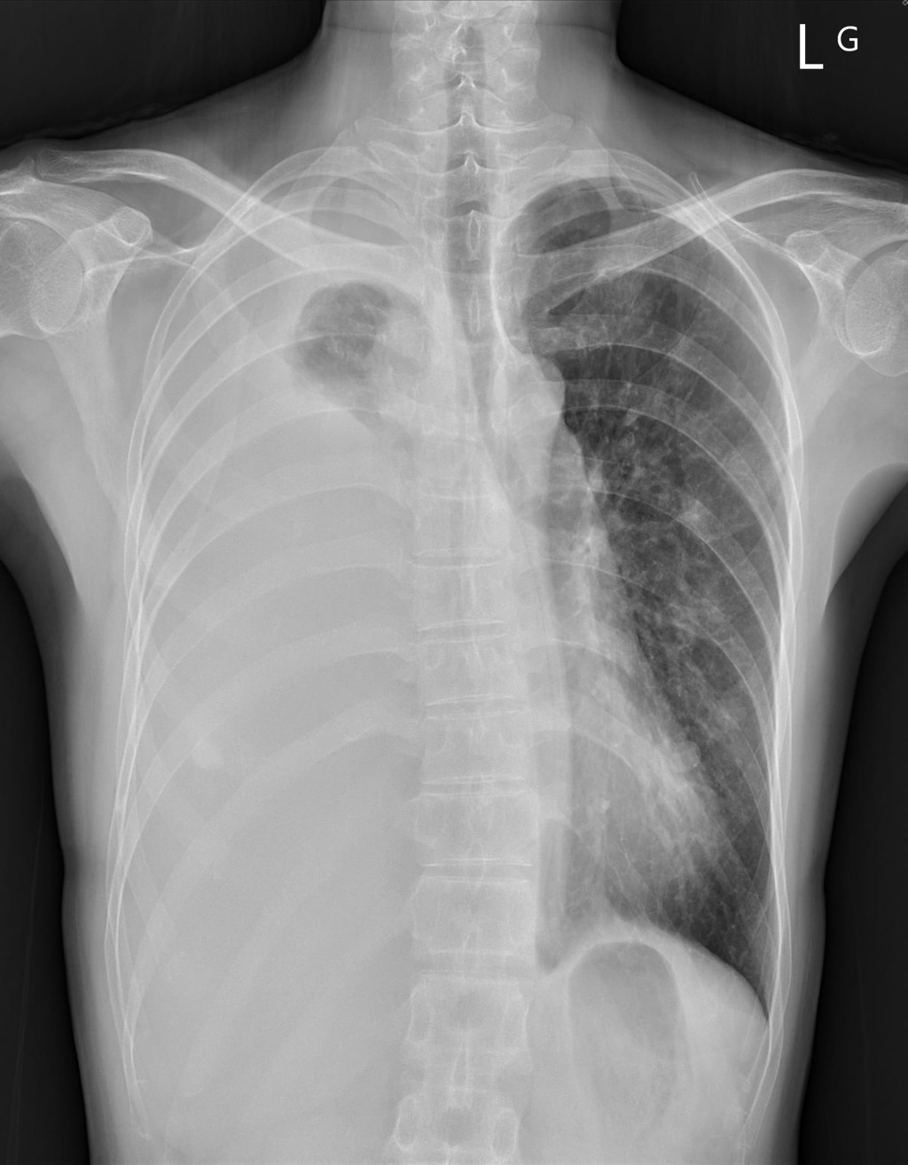 該女子咳嗽1個月後到醫院照X光，揭胸膜有積水患末期肺癌。（圖片來源：蘇一峰醫生Facebook）
