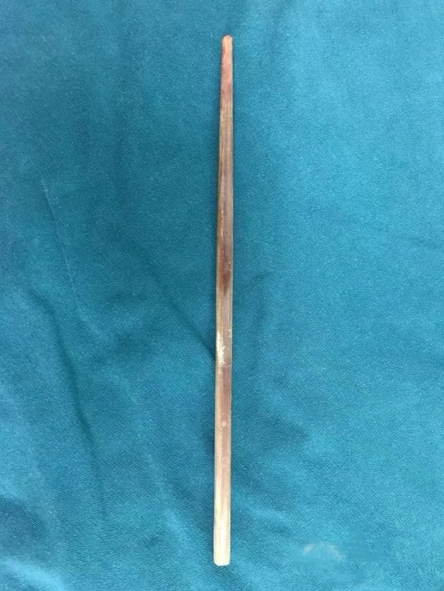 男童經手術後已經取出筷子。網上圖片