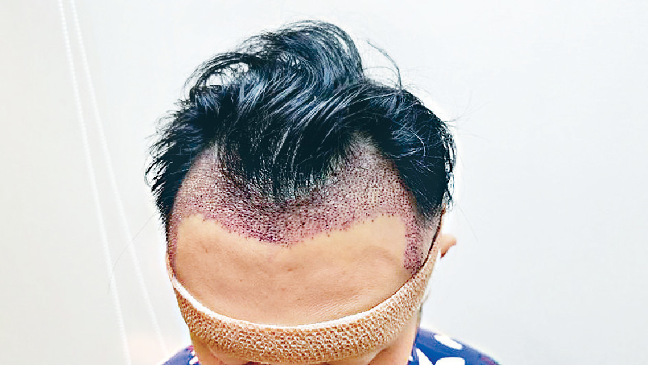 ■手術要將Aaron後腦1800毛囊移植到額前。 ■手術要將Aaron後腦1800毛囊移植到額前。