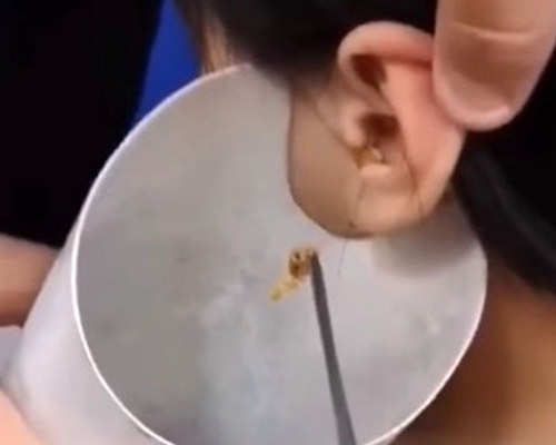 男童聽力出問題求診，醫生夾出巨型耳垢。(網圖)