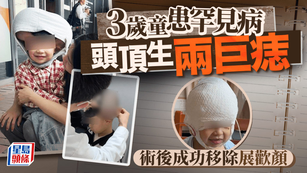 罕見病︱福建3歲童頭頂兩巨痣  5個月兩施手術與「米奇老鼠」說再見