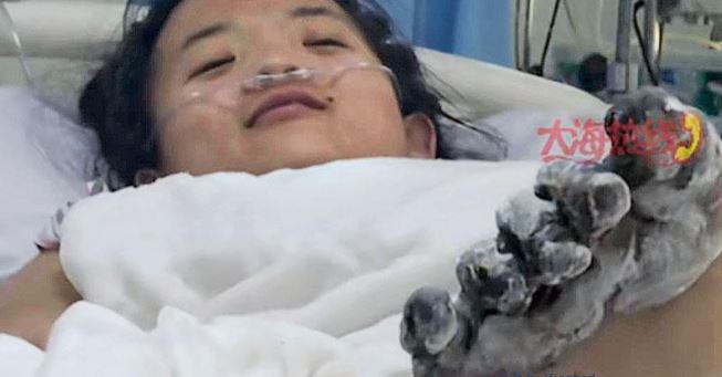 遼寧少女充電玩iPhone漏電要截肢 腳指燒成碳要截肢。  大海新聞