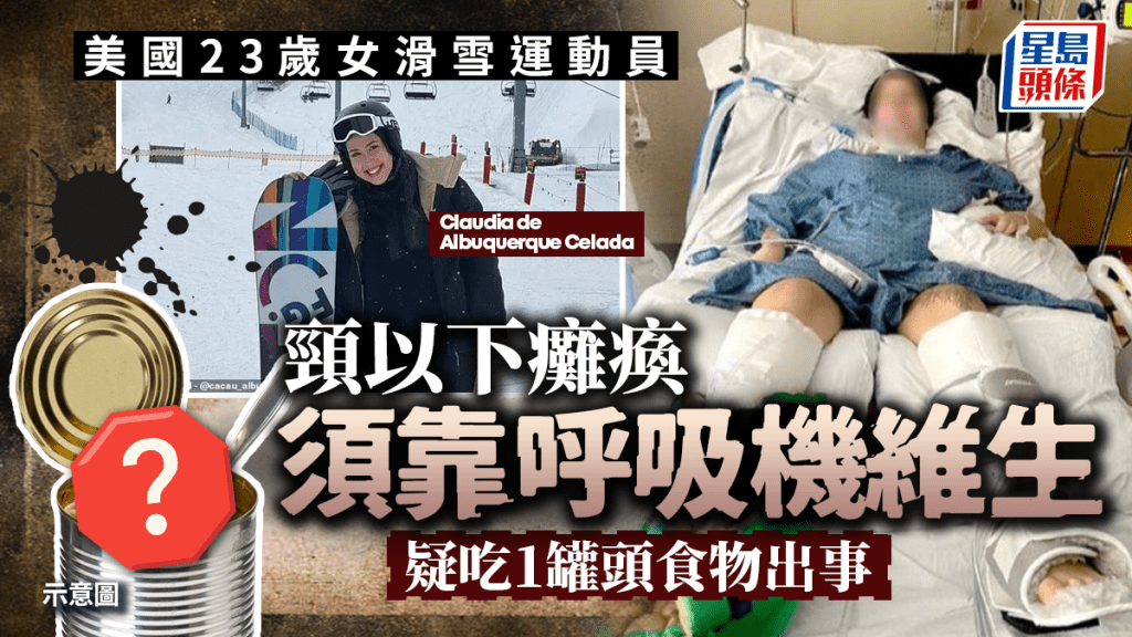 23歲女子吃了一種罐頭食物後 頸以下癱瘓 現要靠呼吸機維生