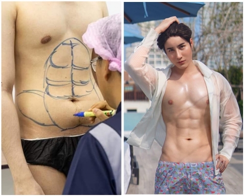 Ome Pangpaparn公開「整腹肌」過程。(圖：Masterpiece Hospital fb )