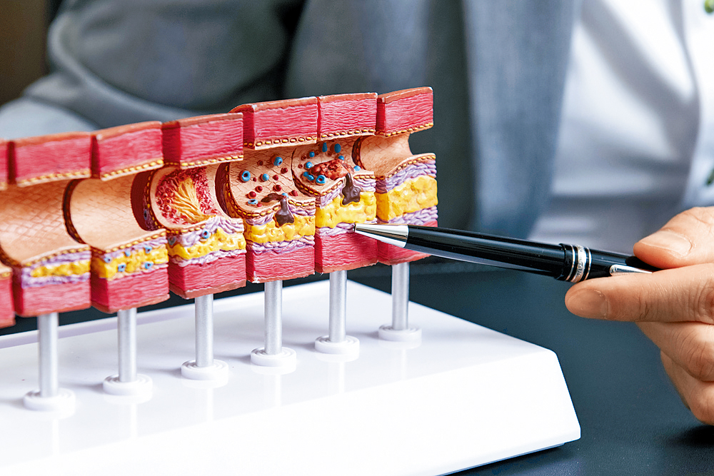 若血管約有7成收窄，並引起心絞痛等症狀或明顯影響心肌血流，便會考慮進行通波仔手術。