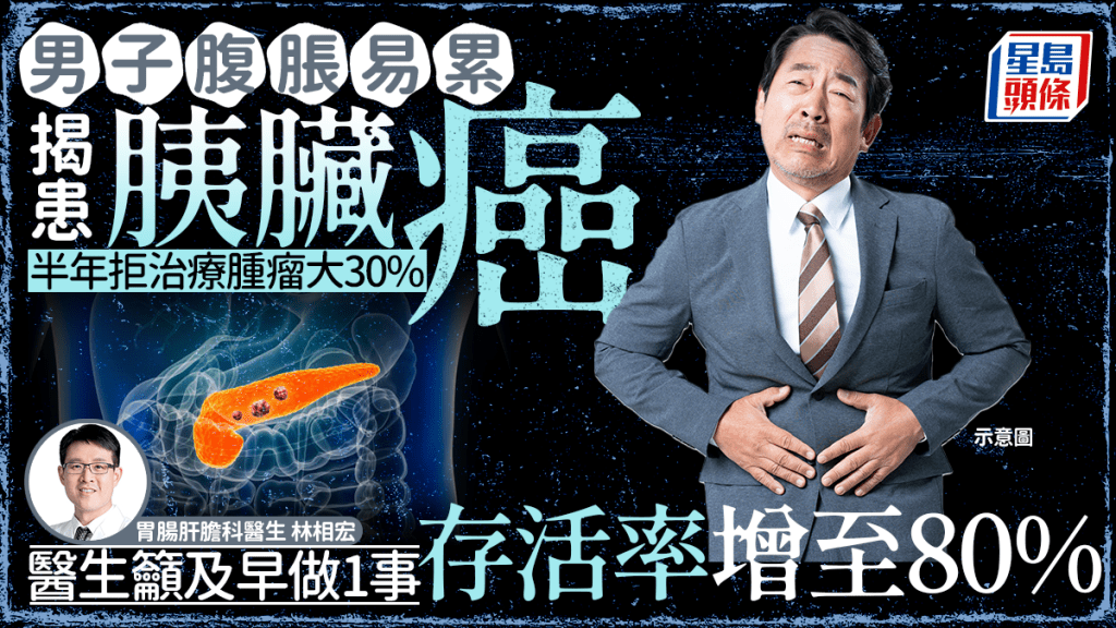 胰臟癌｜男子腹脹易累揭患胰臟癌 半年拒治療腫瘤大30% 醫生籲及早做1事存活率增至80%