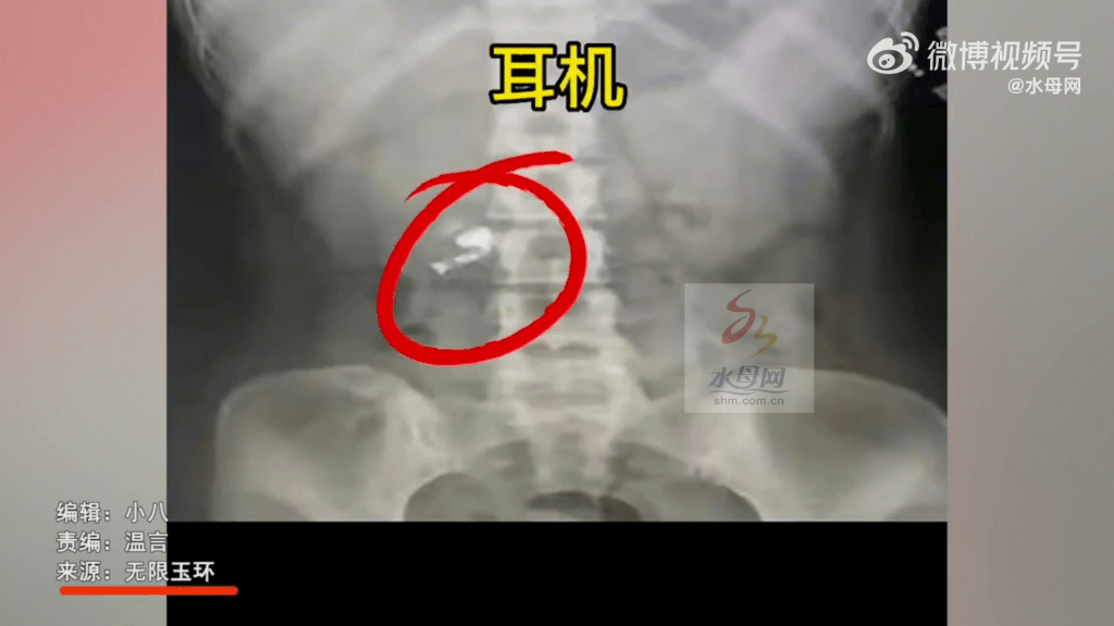 山東男曬出X光影像，其腹部區域確實有一隻耳機橫躺在裡面。