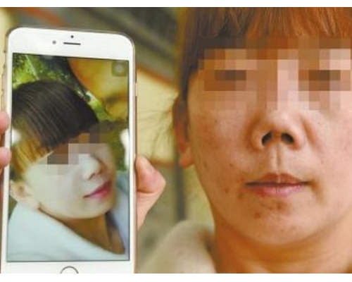 杨小姐哭诉 整成朝天鼻羞于见人。图：腾讯