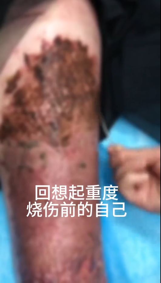 湖北女手機放枕邊通宵叉電，因充電器爆炸燒傷7成皮膚毀容。抖音＠依依的抗疤分享