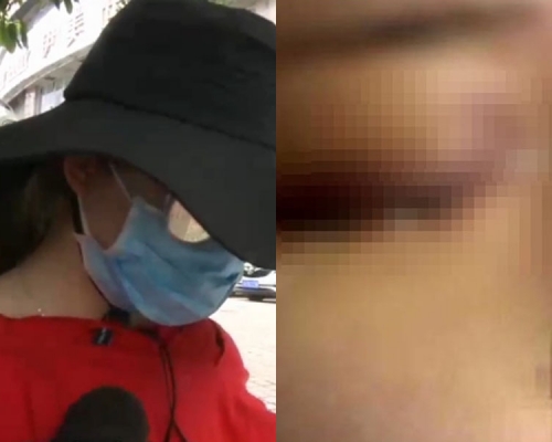 19歲女孩愛美打玻尿酸 ,一針下去眼睛卻失明了!(網圖)
