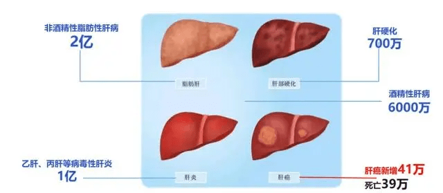 内地非酒精性脂肪肝人数接近2亿。