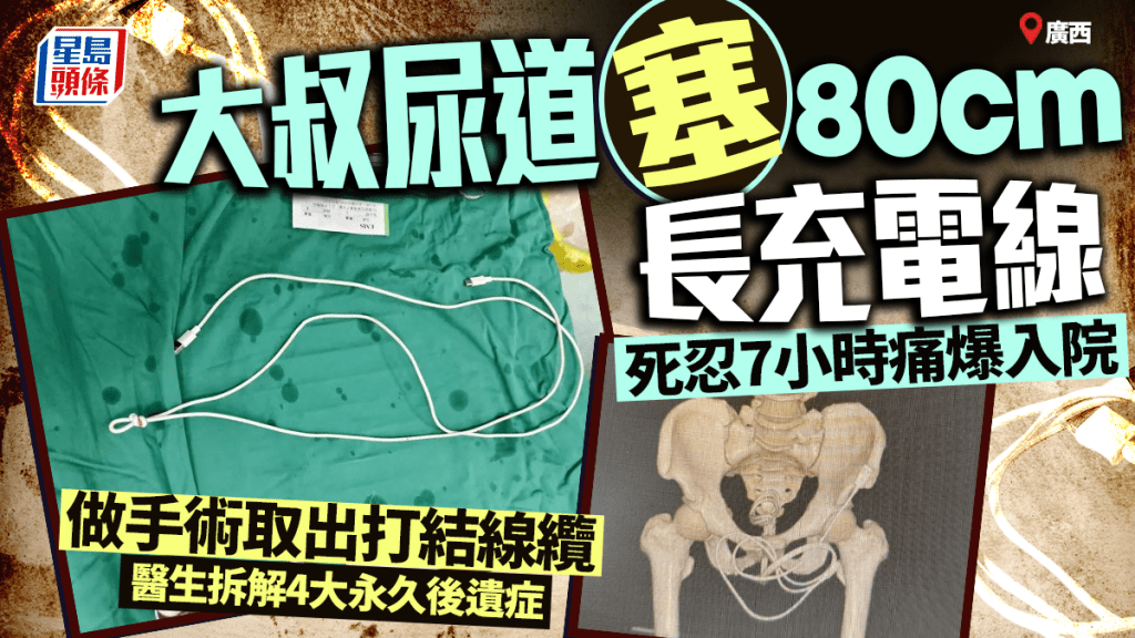49歲大叔尿道塞80cm充電線死忍7小時痛爆入院  醫生拆解4大永久後遺症