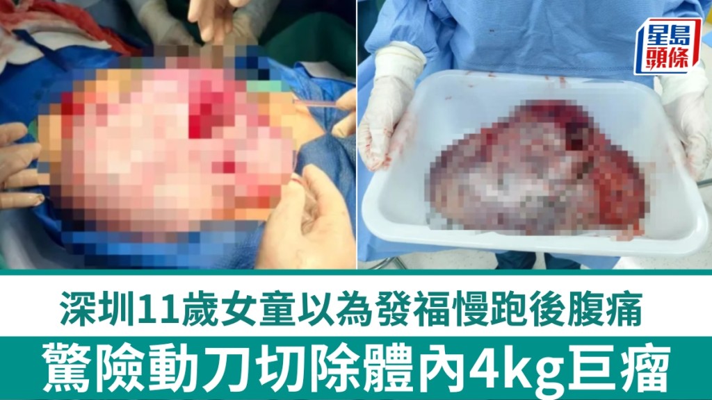深圳女童慢跑後腹痛，驚揭體內竟藏4kg巨瘤，驚險動刀切除。