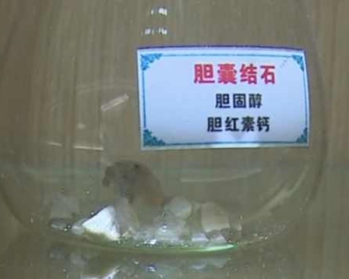 七旬婦長年食素,體內生221粒膽石。網上圖片