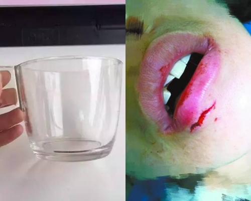北京女飲水突爆杯致崩牙下唇縫針。網上圖片