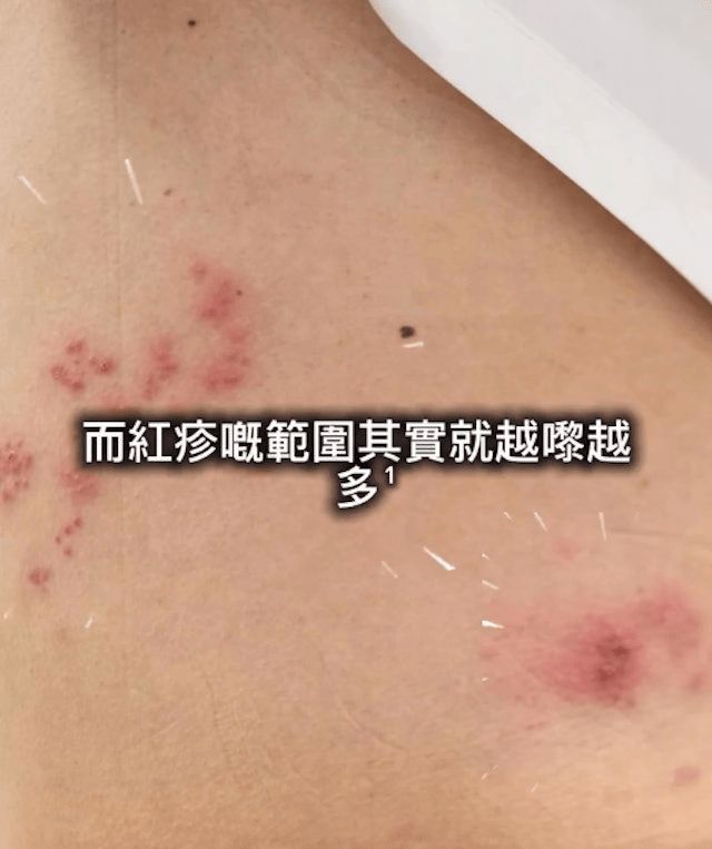 許廷鏗形容生蛇的痛楚「無論做緊咩都會無啦啦好似比針拮一拮咁樣」。