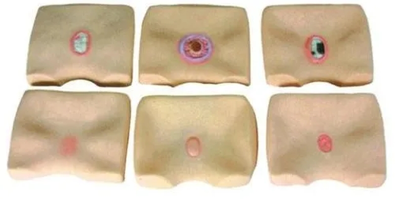 壓瘡示意圖。