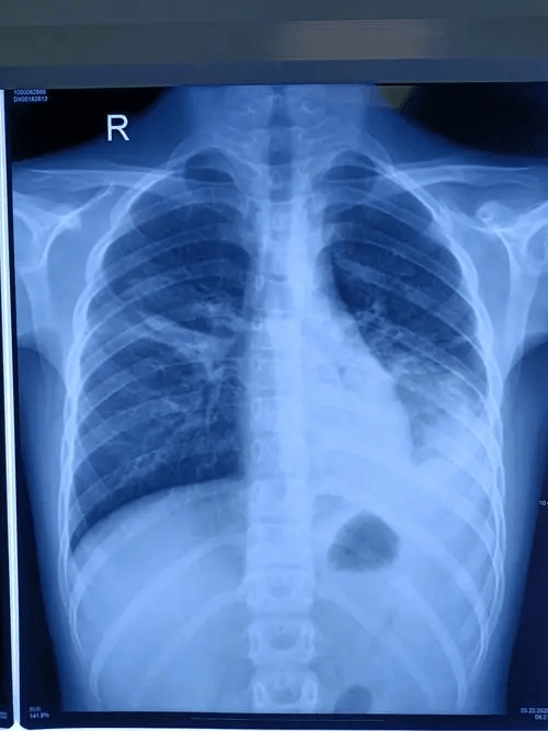 重症「支原體肺炎」患者肺部X光片。