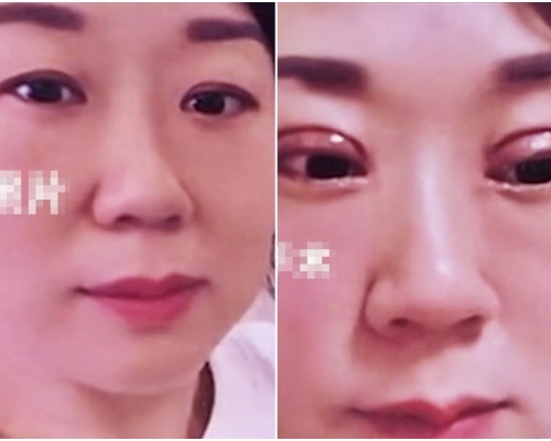 江西一名人妻進行割雙眼皮手術，怎料卻手術失敗。網圖