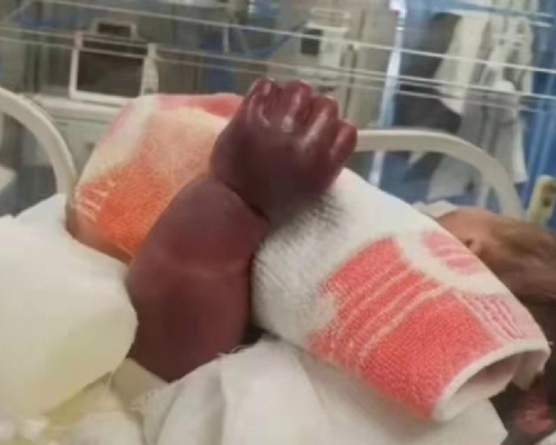嬰兒的左臂被橡筋束起半日後，又腫又黑，有如一條茄子。 （網上圖片）
