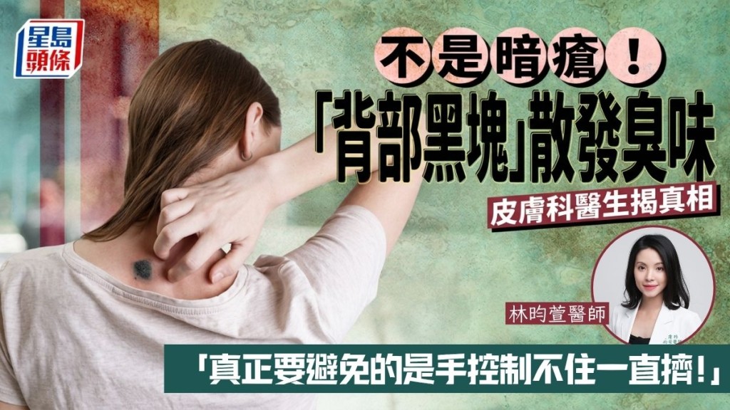 不是暗疮！「黑色肿块」散发臭味 皮肤科医生揭真相 当粉刺乱挤恐出事