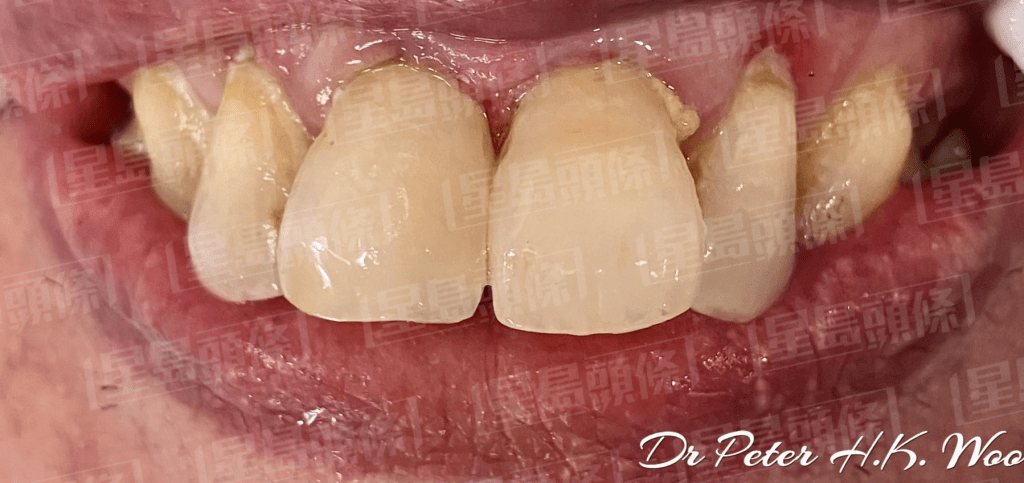 蛀牙患者接受治療後的情況（相片來源：牙科醫生胡瀚鈞）