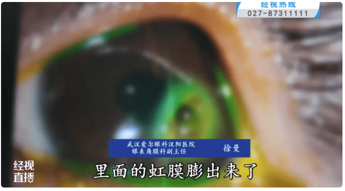 ５歲女童小星（化名）眼睛因為蟎蟲感染，令雙眼經常佈滿紅血絲，最終導致角膜穿孔，需要接受角膜移植手術。（截圖自《經視直播》）