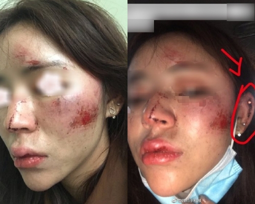 成都女子深夜回家被三男子調戲還遭毆打致面部受傷,皮損流血。(網圖)