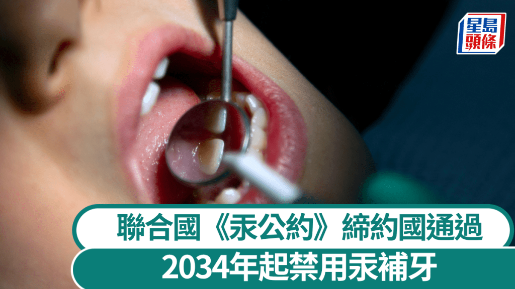 銀汞補牙2034年起禁用。  法新社示意圖