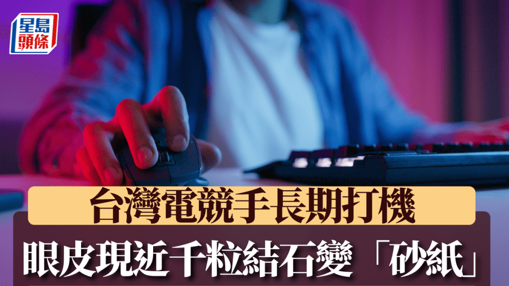 台灣一名電競手因長時間用3C產品，令眼皮出現近千粒結石。iStock示意圖