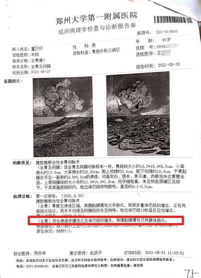 術後兩次做病理學檢查,均顯示非胃癌。 術後兩次做病理學檢查,均顯示非胃癌。
