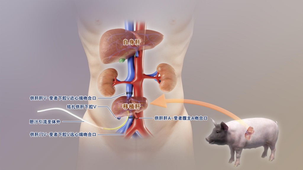 第五位：基因编辑猪肝植入人体突破跨物种器官移植壁垒。