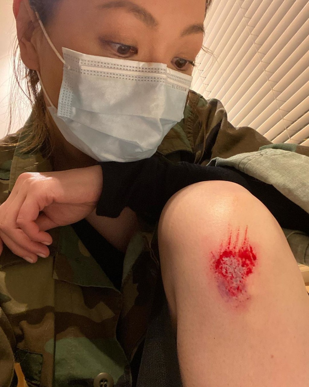阿田膝頭的傷口唔細，睇見都痛！