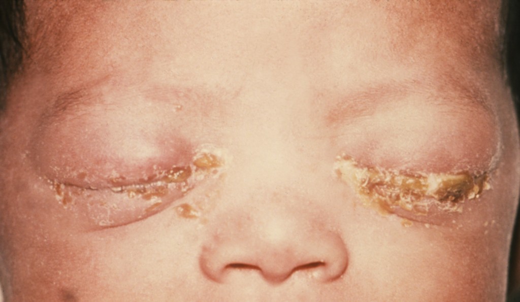 眼睛受淋球菌感染的嬰兒。 Wiki